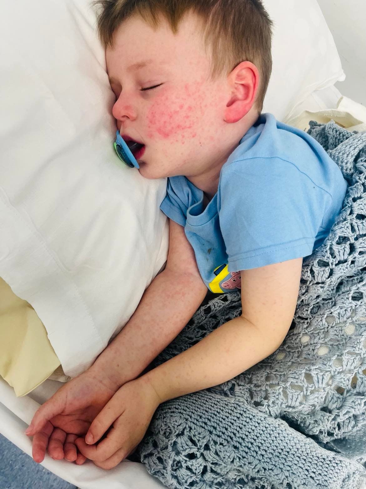 RASH SIGNS: Joey (4) in hospital this week