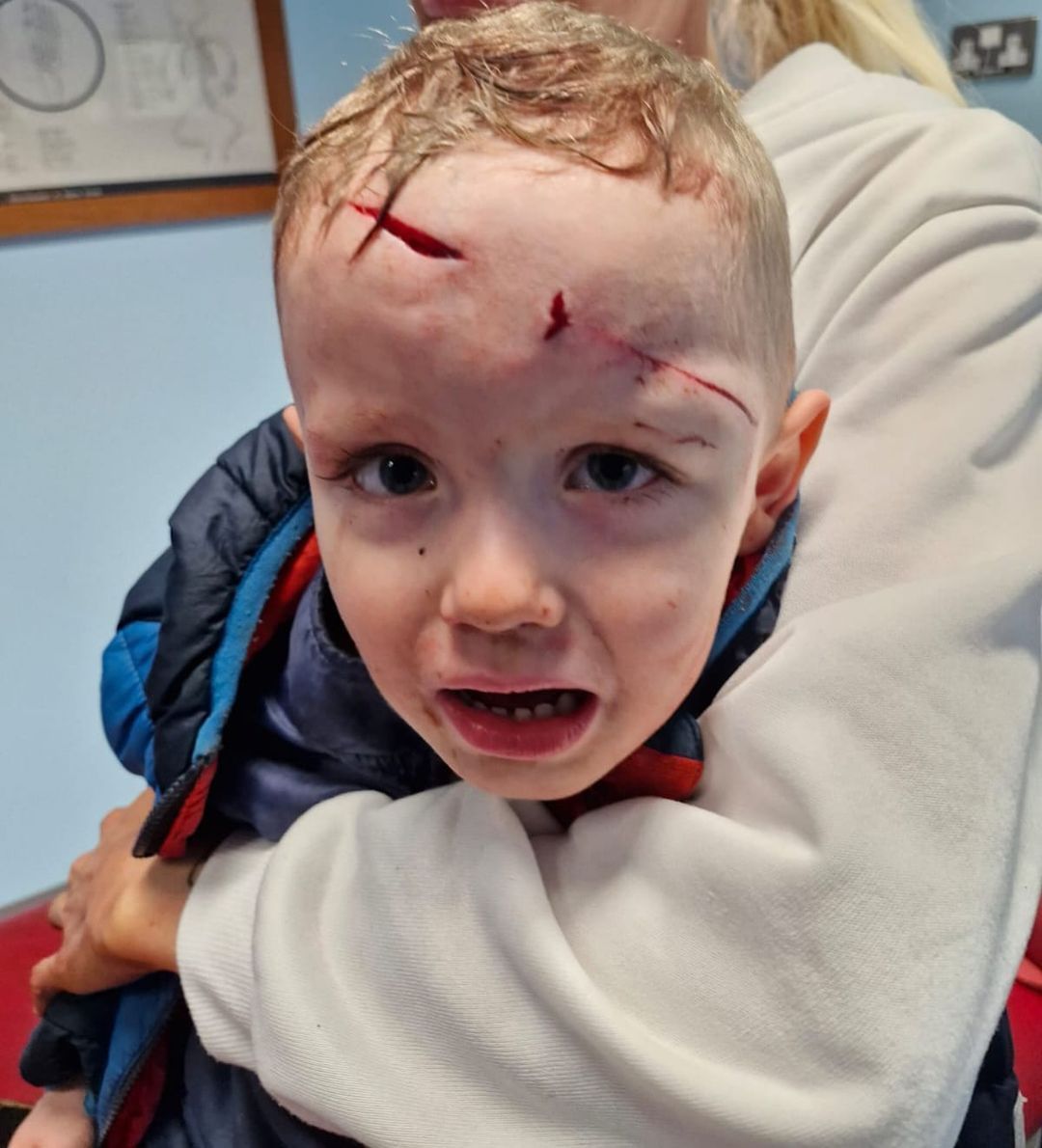 HORRIFIC ORDEAL: Keaghán (3) after he was attacked by a dog