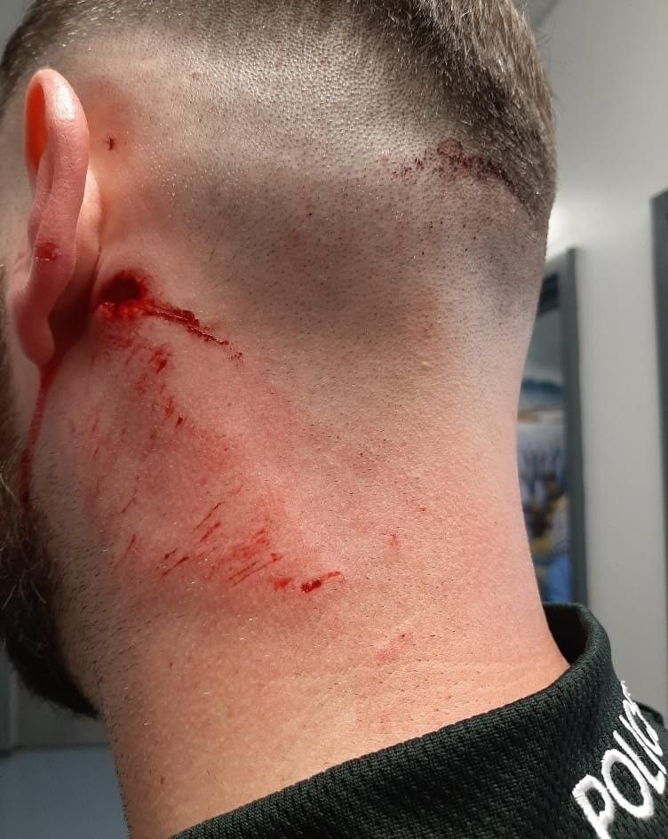 ATTACKED: The injury that the police officer received on Thursday night