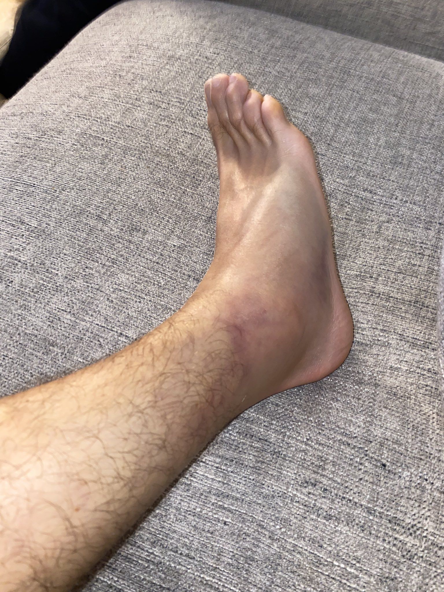 Michael Conlan shared a picture of his injured right ankle on social media