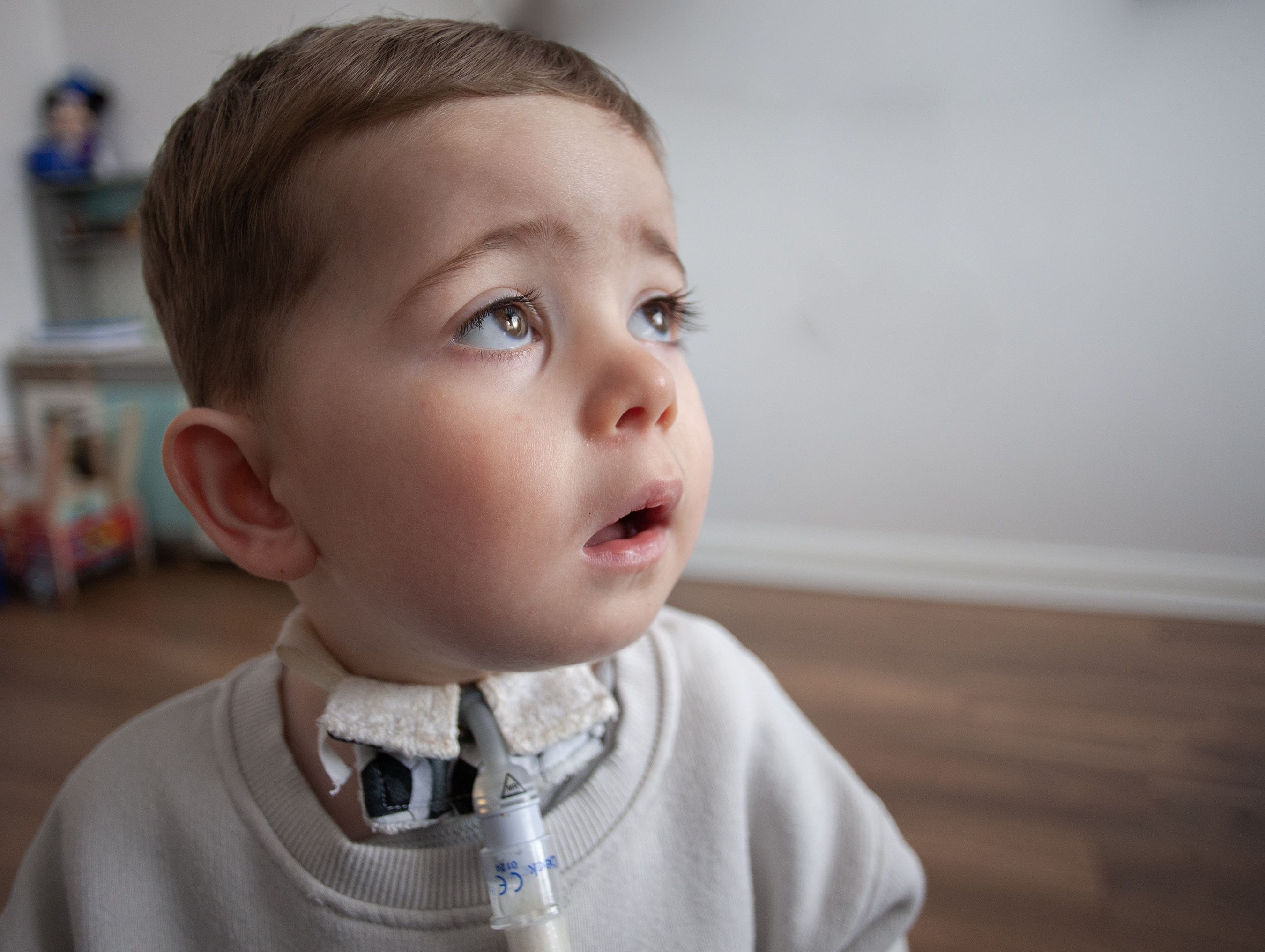 Riogán was diagnosed at just 4 weeks old and his trachea is part of the norm