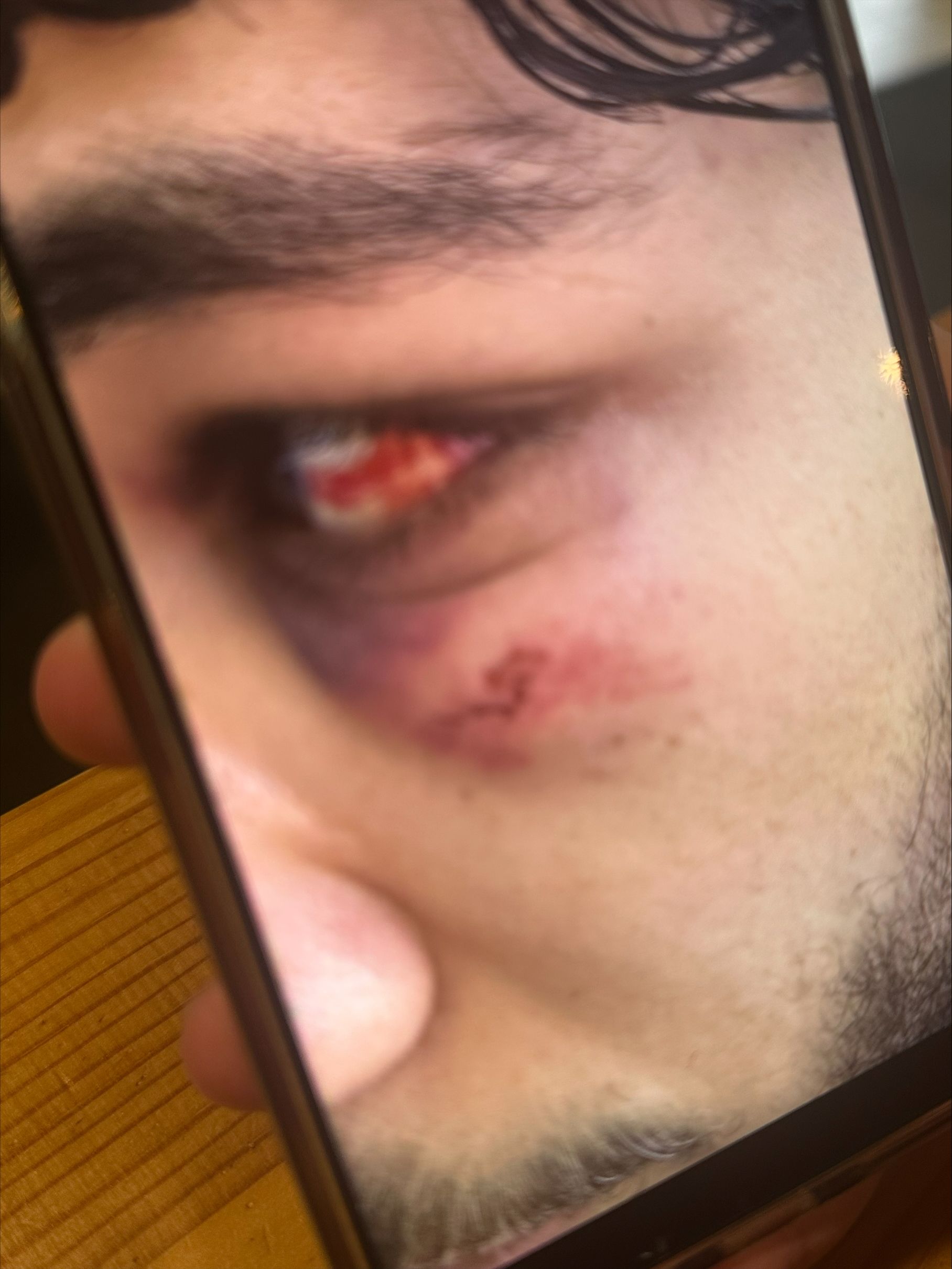 An image of the damage caused to Mohammed’s eye captured on his mobile phone