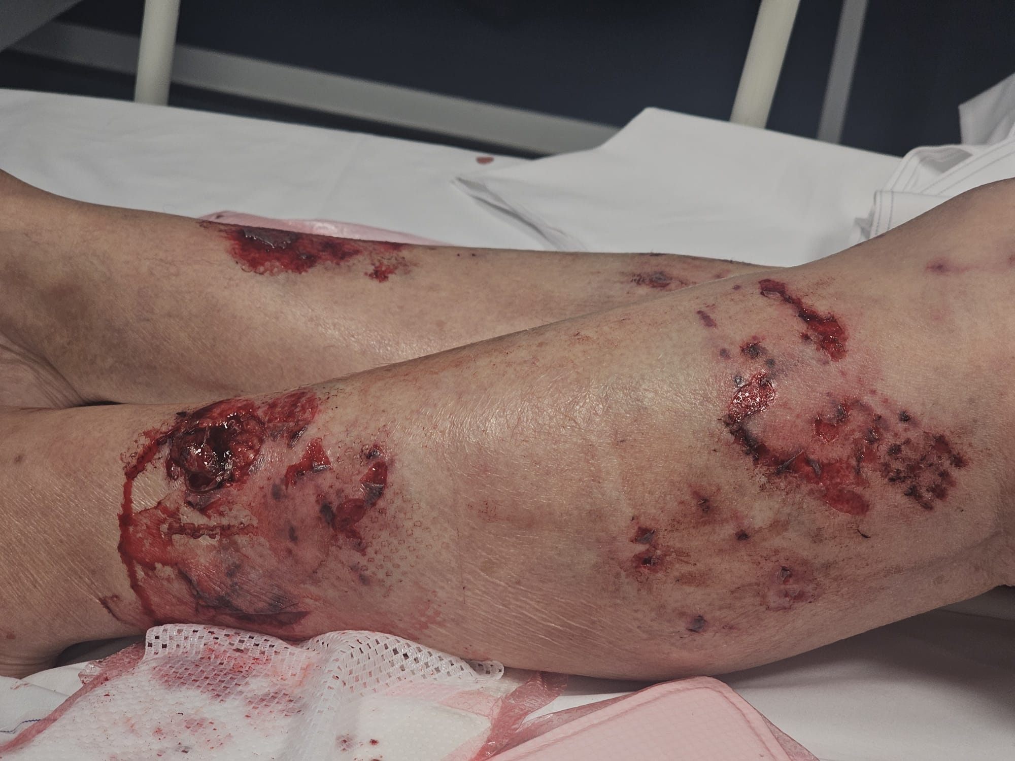 Sheila's legs after the vicious attack