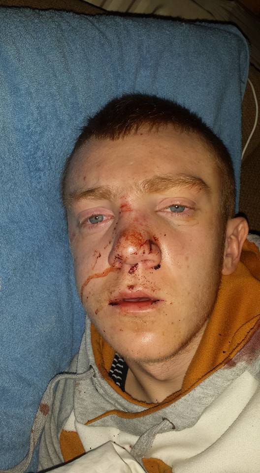 Nathan Daly (16) pictured after the attack in a photo posted on his brother’s Facebook page