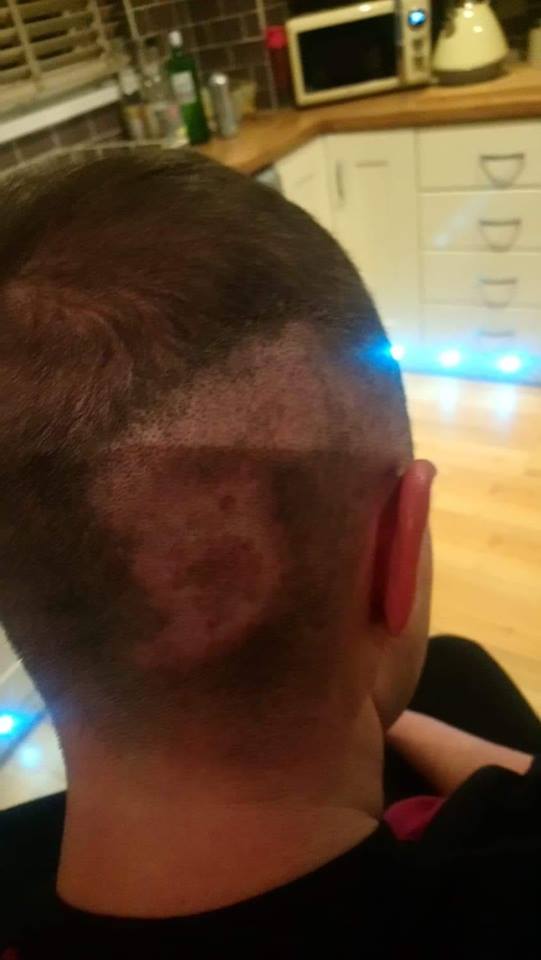 The teen had a lucky escape after was hit with a firework from behind last week